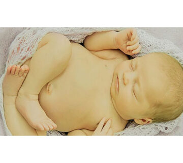 زردی نوزاد چیست؟